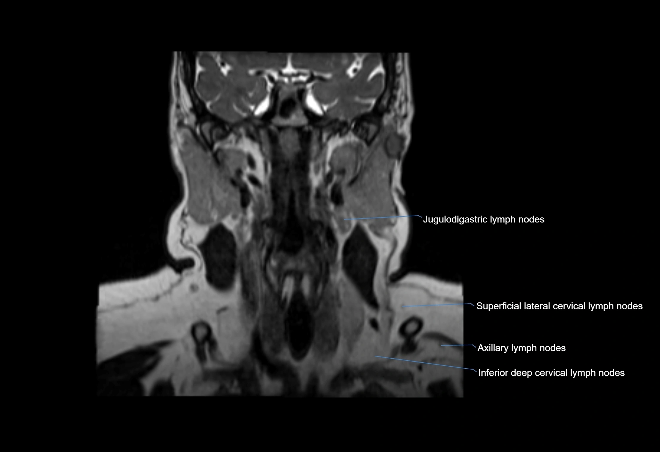 Neck coronal lymph node cross sectional MRI anatomy 3T MRI  image-img-00001-00039.webp